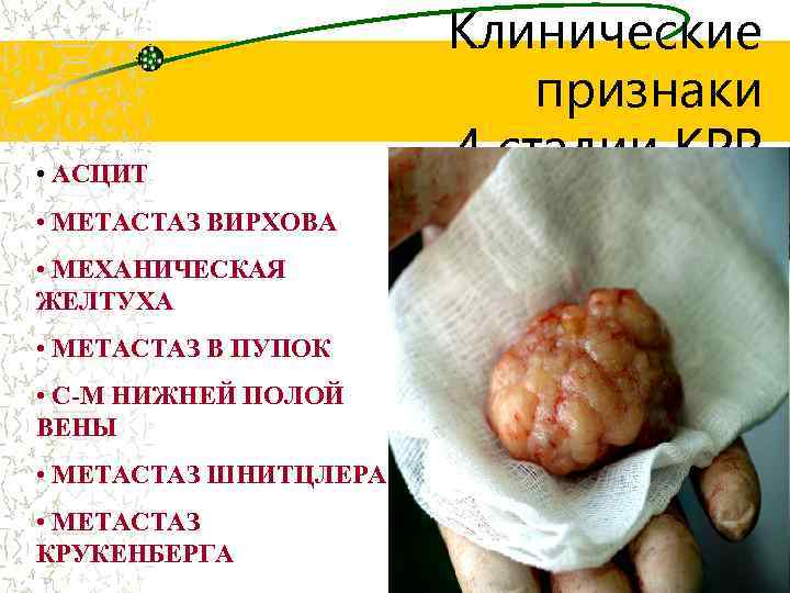  • АСЦИТ • МЕТАСТАЗ ВИРХОВА • МЕХАНИЧЕСКАЯ ЖЕЛТУХА • МЕТАСТАЗ В ПУПОК •