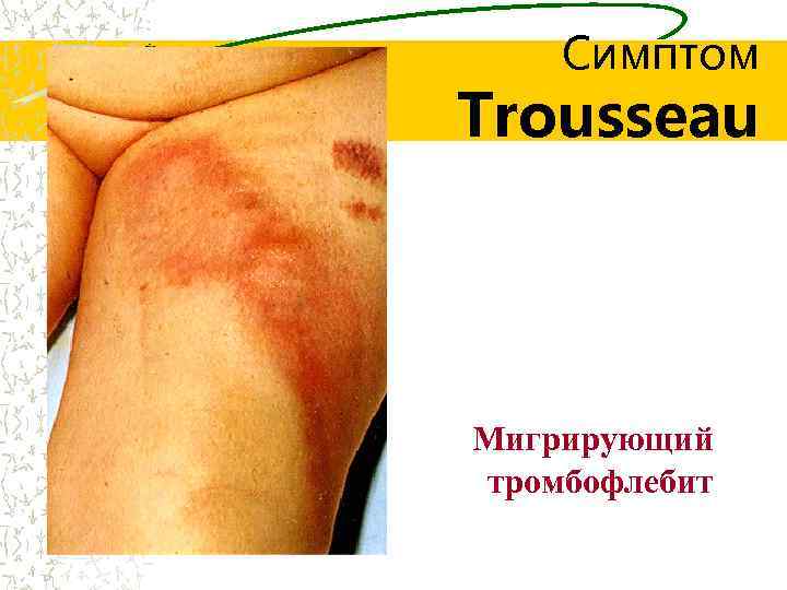 Симптом Trousseau Мигрирующий тромбофлебит 