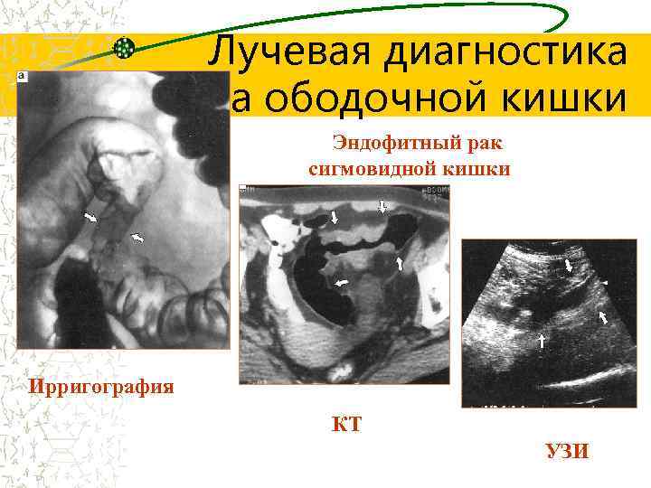 Лучевая диагностика рака ободочной кишки Эндофитный рак сигмовидной кишки Ирригография КТ УЗИ 