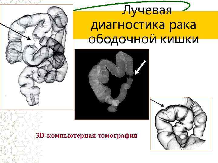Лучевая диагностика рака ободочной кишки 3 D-компьютерная томография 
