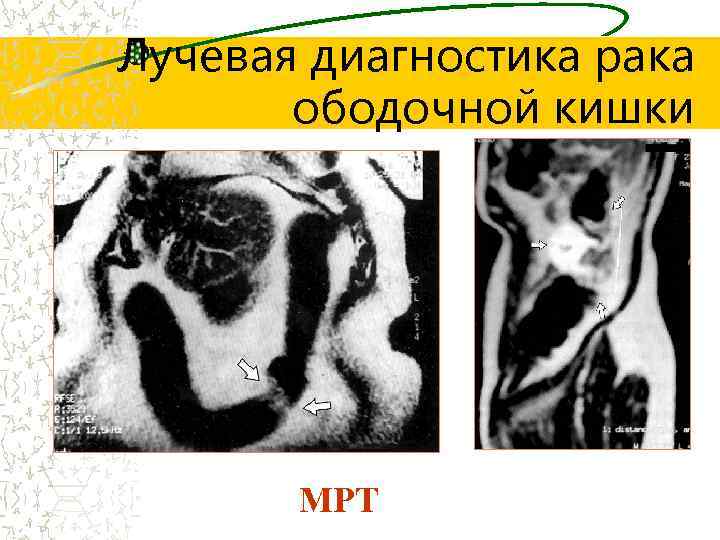 Лучевая диагностика рака ободочной кишки МРТ 