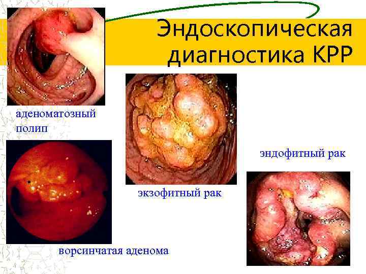 Эндоскопическая диагностика КРР аденоматозный полип эндофитный рак экзофитный рак ворсинчатая аденома 