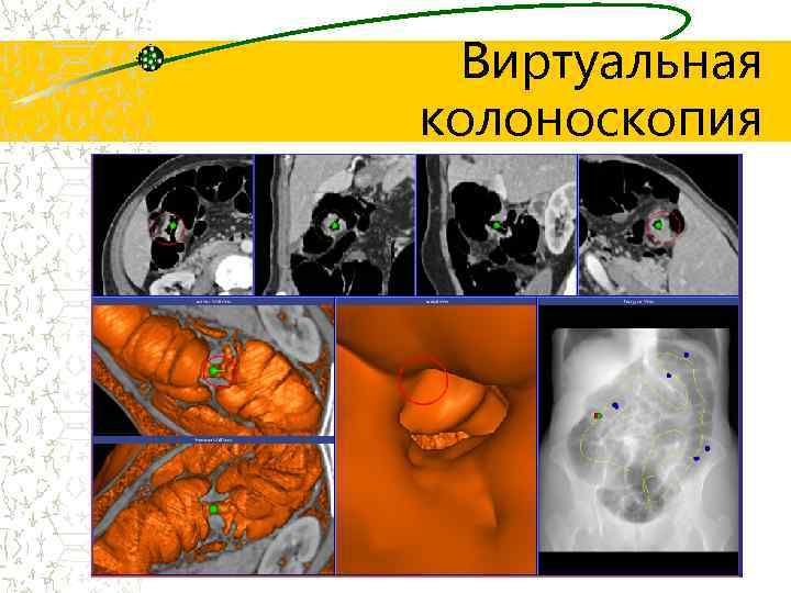Виртуальная колоноскопия 