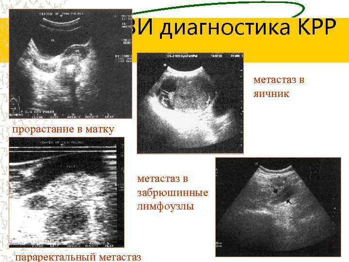 УЗИ диагностика КРР метастаз в яичник прорастание в матку метастаз в забрюшинные лимфоузлы параректальный