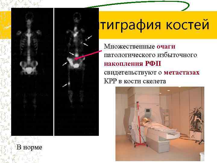 Сцинтиграфия костей Множественные очаги патологического избыточного накопления РФП свидетельствуют о метастазах КРР в кости