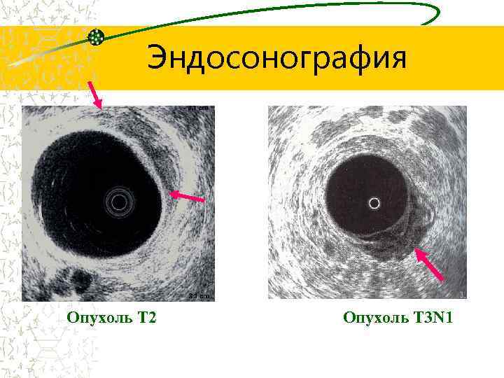 Эндосонография Опухоль Т 2 Опухоль Т 3 N 1 