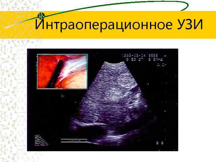 Интраоперационное УЗИ 