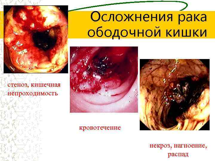 Осложнения рака ободочной кишки стеноз, кишечная непроходимость кровотечение некроз, нагноение, распад 