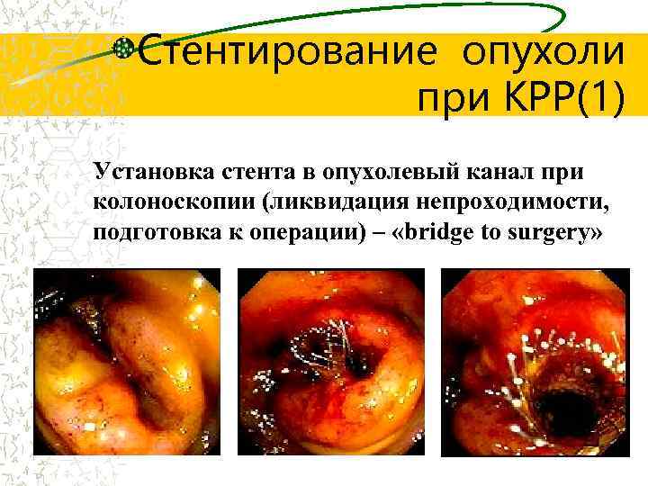 Стентирование опухоли при КРР(1) Установка стента в опухолевый канал при колоноскопии (ликвидация непроходимости, подготовка