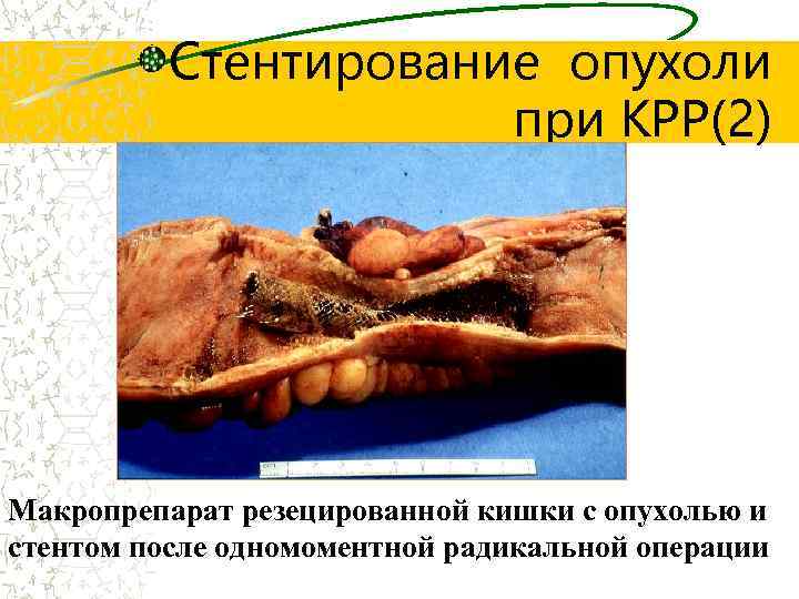 Стентирование опухоли при КРР(2) Макропрепарат резецированной кишки с опухолью и стентом после одномоментной радикальной