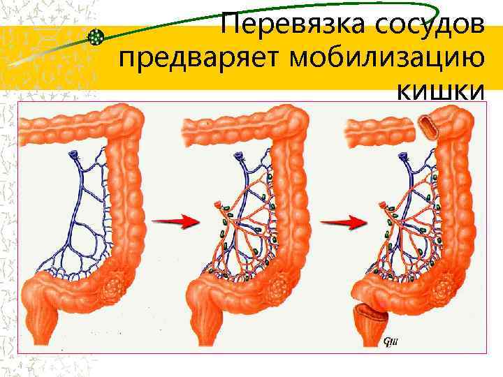 Перевязка сосудов предваряет мобилизацию кишки 