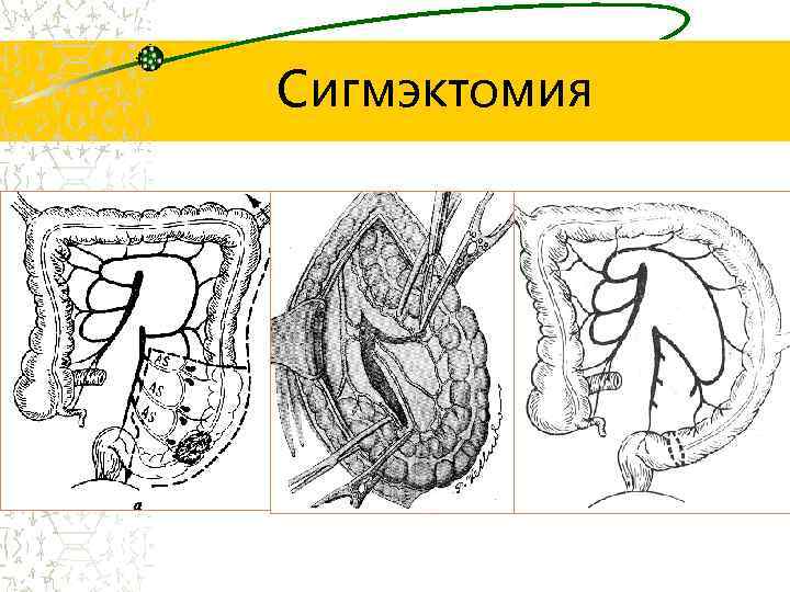 Сигмэктомия 