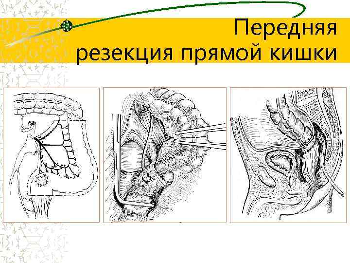 Передняя резекция прямой кишки 