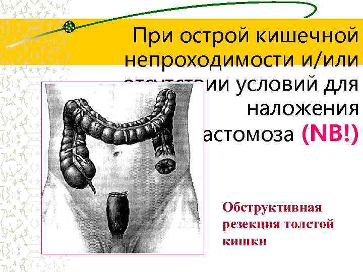 При острой кишечной непроходимости и/или отсутствии условий для наложения анастомоза (NB!) Обструктивная резекция толстой