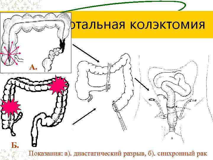 Субтотальная колэктомия А. Б. Показания: а). диастатический разрыв, б). синхронный рак 