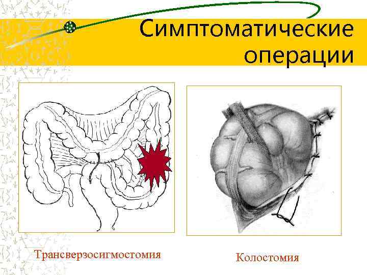 Симптоматические операции Трансверзосигмостомия Колостомия 