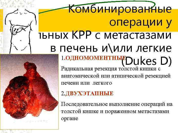 Комбинированные операции у больных КРР с метастазами в печень иили легкие 1. ОДНОМОМЕНТНЫЕ (Dukes
