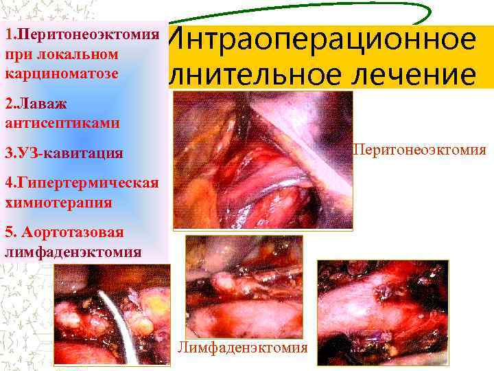 Интраоперационное дополнительное лечение 1. Перитонеоэктомия при локальном карциноматозе 2. Лаваж антисептиками Перитонеоэктомия 3. УЗ-кавитация