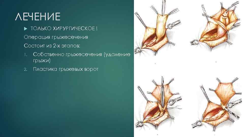 ЛЕЧЕНИЕ ТОЛЬКО ХИРУРГИЧЕСКОЕ ! Операция грыжесечения Состоит из 2 -х этапов: 1. Собственно грыжесечения