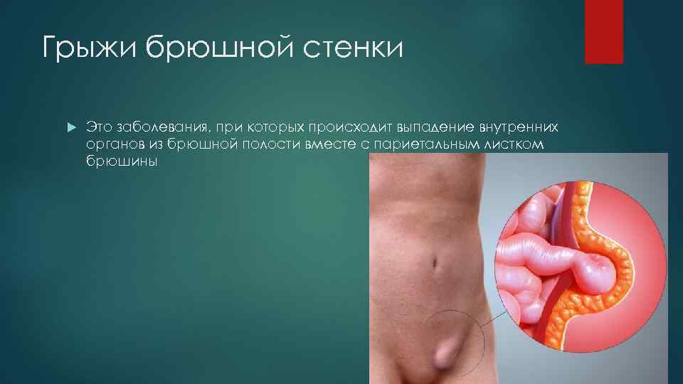 Грыжи брюшной стенки Это заболевания, при которых происходит выпадение внутренних органов из брюшной полости