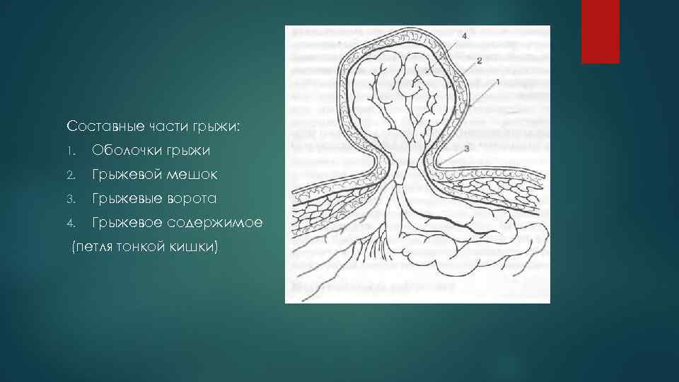 Составные части грыжи: 1. Оболочки грыжи 2. Грыжевой мешок 3. Грыжевые ворота 4. Грыжевое