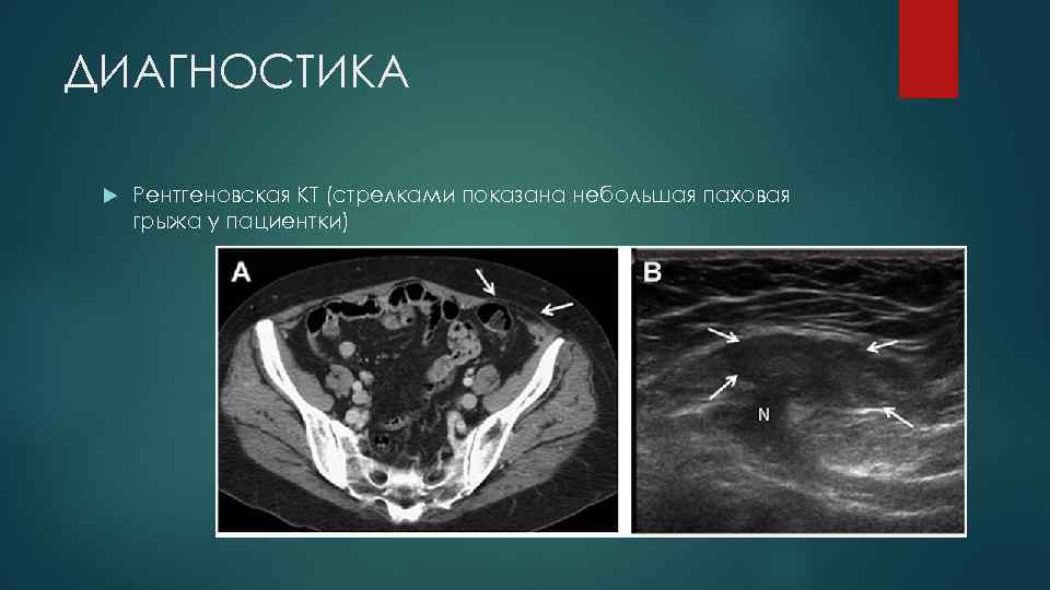 ДИАГНОСТИКА Рентгеновская КТ (стрелками показана небольшая паховая грыжа у пациентки) 