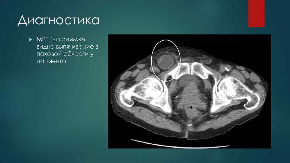 Диагностика МРТ (на снимке видно выпячивание в паховой области у пациента) 
