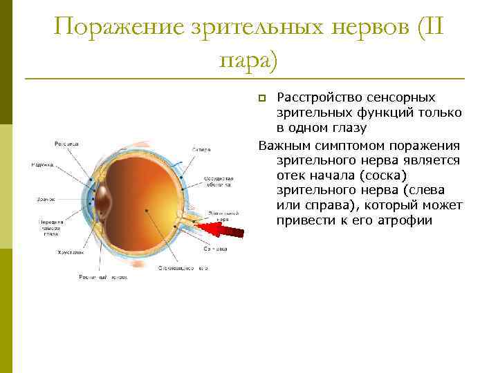 Поражение зрительных нервов (II пара) Расстройство сенсорных зрительных функций только в одном глазу Важным
