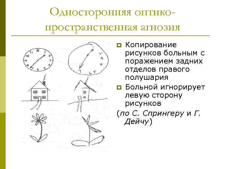 Односторонняя оптикопространственная агнозия Копирование рисунков больным с поражением задних отделов правого полушария p Больной