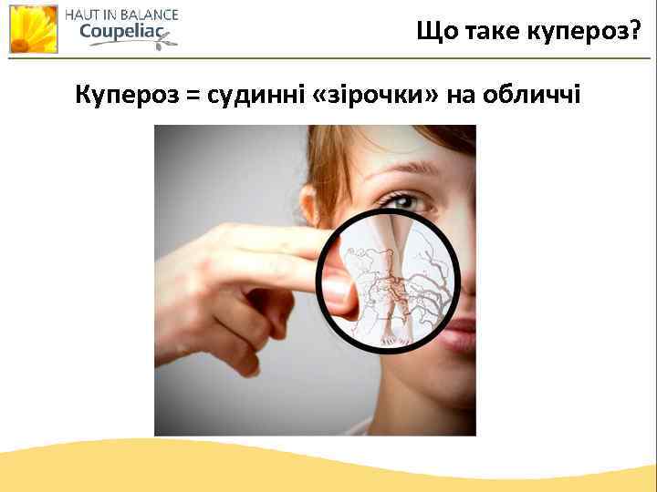Що таке купероз? Купероз = судинні «зірочки» на обличчі 