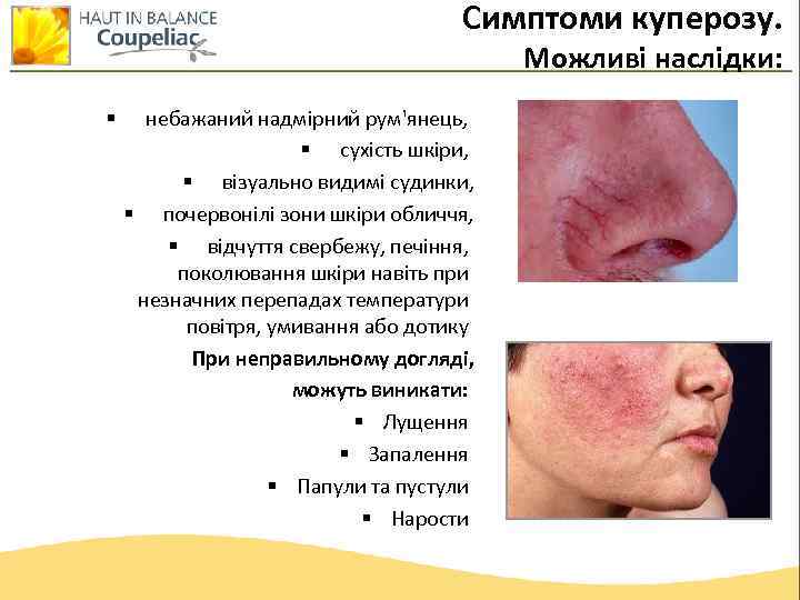Симптоми куперозу. Можливі наслідки: § небажаний надмірний рум'янець, § сухість шкіри, § візуально видимі