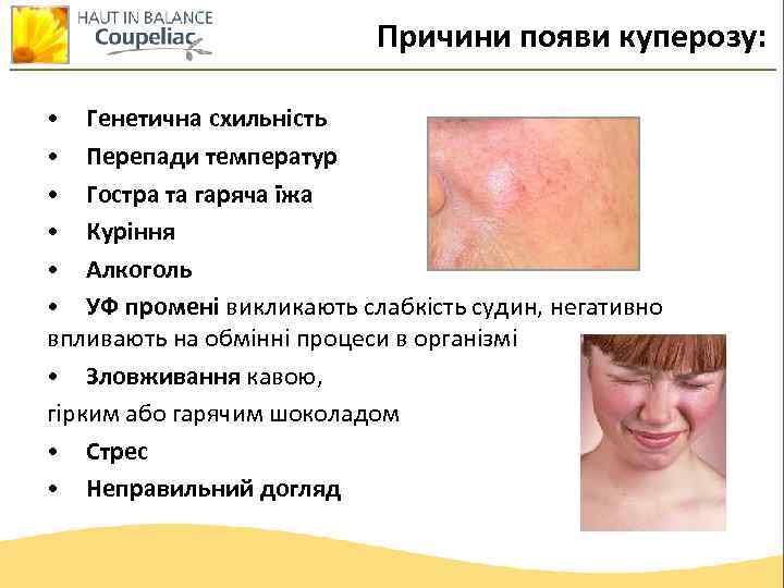 Причини появи куперозу: • Генетична схильність • Перепади температур • Гостра та гаряча їжа