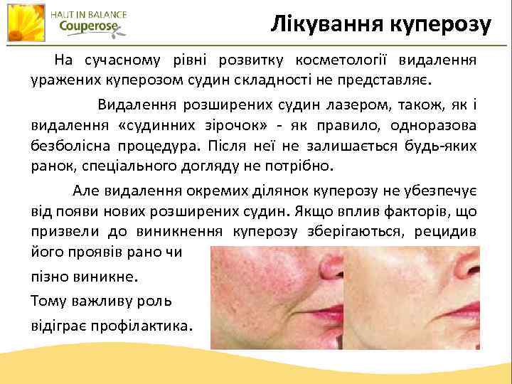 Лікування куперозу На сучасному рівні розвитку косметології видалення уражених куперозом судин складності не представляє.