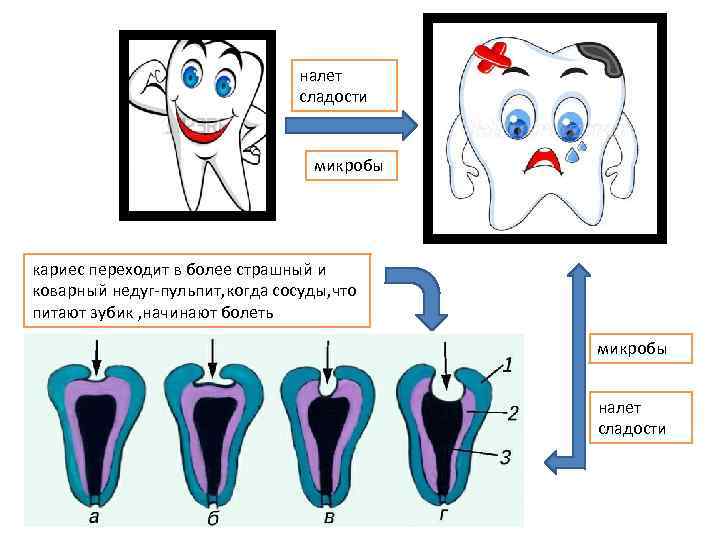 налет сладости микробы кариес переходит в более страшный и коварный недуг-пульпит, когда сосуды, что
