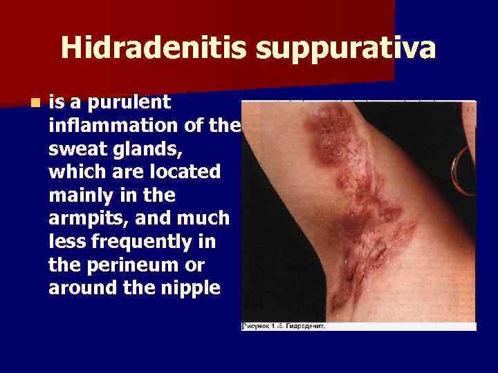 Hidradenitis suppurativa n is a purulent inflammation of the sweat glands, which are located