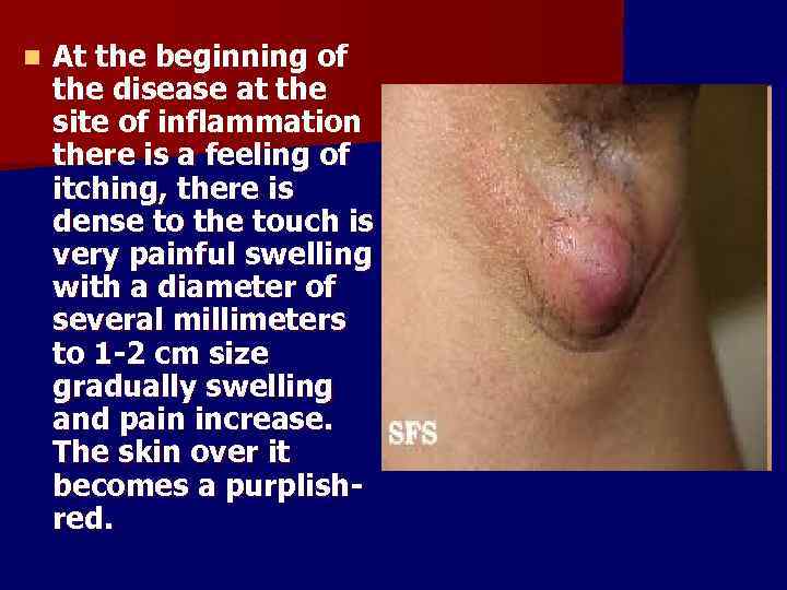 n At the beginning of the disease at the site of inflammation there is