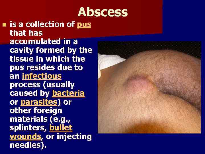 Abscess n is a collection of pus that has accumulated in a cavity formed