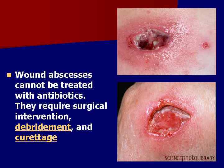 n Wound abscesses cannot be treated with antibiotics. They require surgical intervention, debridement, and
