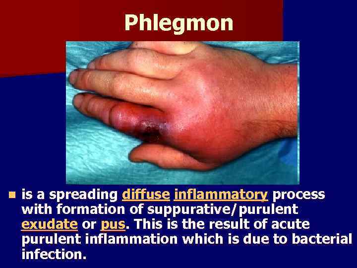 Phlegmon n is a spreading diffuse inflammatory process with formation of suppurative/purulent exudate or