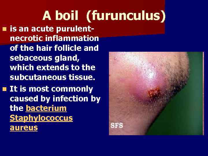 A boil (furunculus) is an acute purulentnecrotic inflammation of the hair follicle and sebaceous