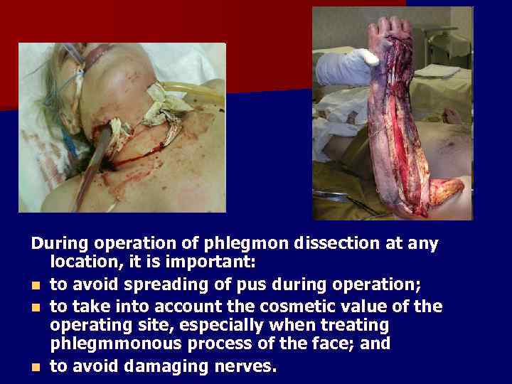 During operation of phlegmon dissection at any location, it is important: n to avoid
