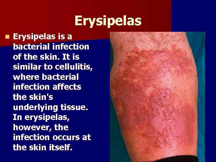 Erysipelas n Erysipelas is a bacterial infection of the skin. It is similar to
