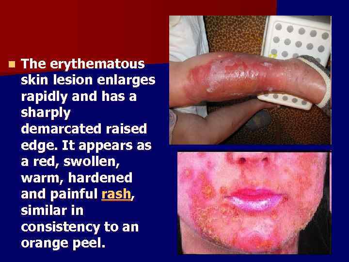 n The erythematous skin lesion enlarges rapidly and has a sharply demarcated raised edge.