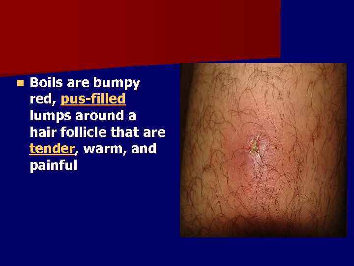 n Boils are bumpy red, pus-filled lumps around a hair follicle that are tender,