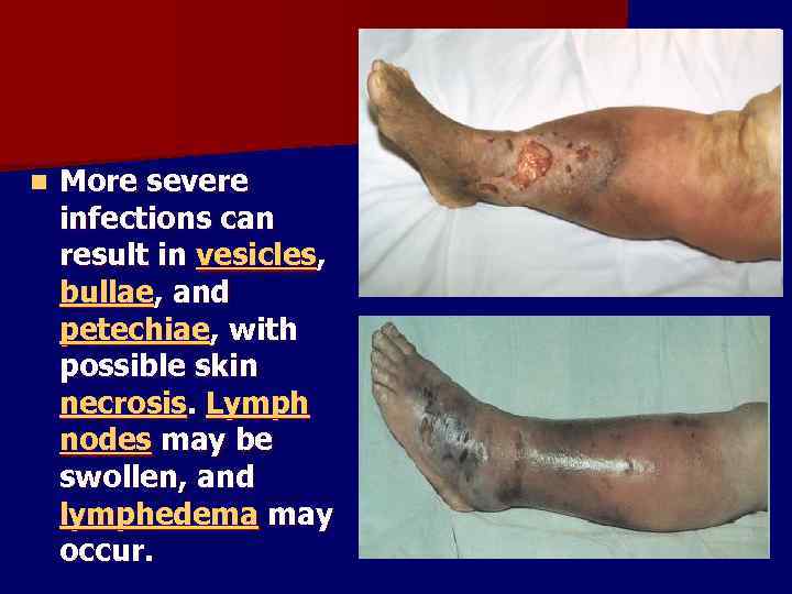 n More severe infections can result in vesicles, bullae, and petechiae, with possible skin