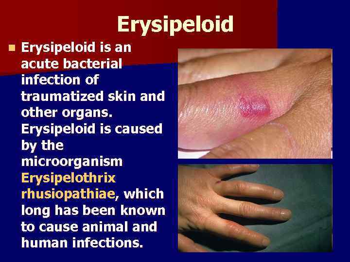 Erysipeloid n Erysipeloid is an acute bacterial infection of traumatized skin and other organs.