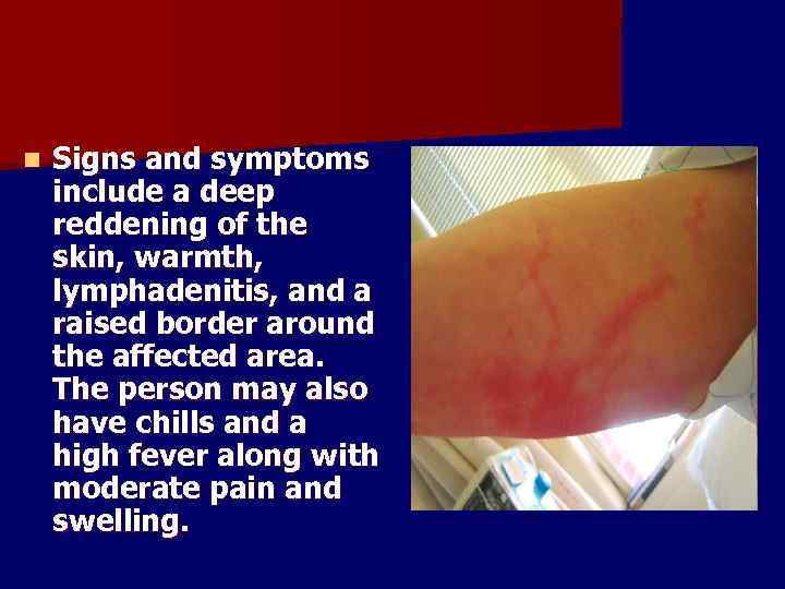 n Signs and symptoms include a deep reddening of the skin, warmth, lymphadenitis, and
