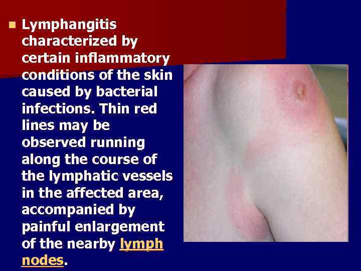 n Lymphangitis characterized by certain inflammatory conditions of the skin caused by bacterial infections.