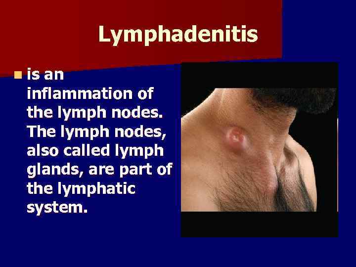 Lymphadenitis n is an inflammation of the lymph nodes. The lymph nodes, also called