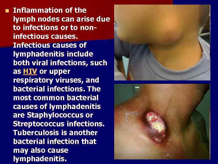 n Inflammation of the lymph nodes can arise due to infections or to noninfectious